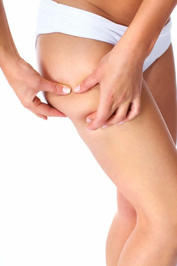 Réduire la cellulite : alimentation, soins ou médecine esthétique ?